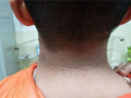 13岁男孩脖子洗不干净确诊黑棘皮病：胰岛素失控所致!