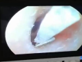 女生睡觉不摘耳钉：直径4mm钻掉耳道 卡了半个月！