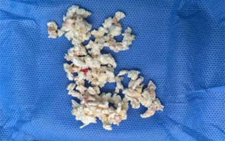 每天两碗！六旬老伯爱喝骨头汤：膝盖长满痛风石!