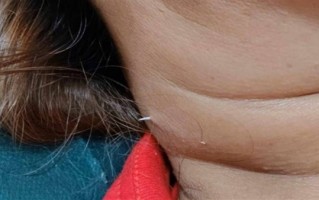 泰国女子吃鱼时被鱼刺扎穿脖子：医生直呼活久见！