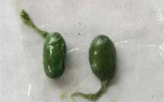 毒性胜过砒霜：2人轻信偏方生吞鱼胆致器官衰竭！