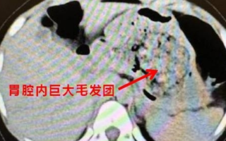 浙江一5岁女孩确诊长发公主综合征：胃里一大团头发 医生都懵了！