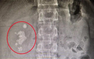 男子查出肾结石未重视拖成大麻烦：发展为铸型结石填满肾脏！