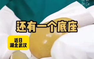 老人长期吃素胆囊长出金蛋状结石 医生：四类人群需注意!