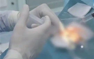 38岁女子宅家熬夜刷手机 眼压飙升诱发青光眼险失明 ！